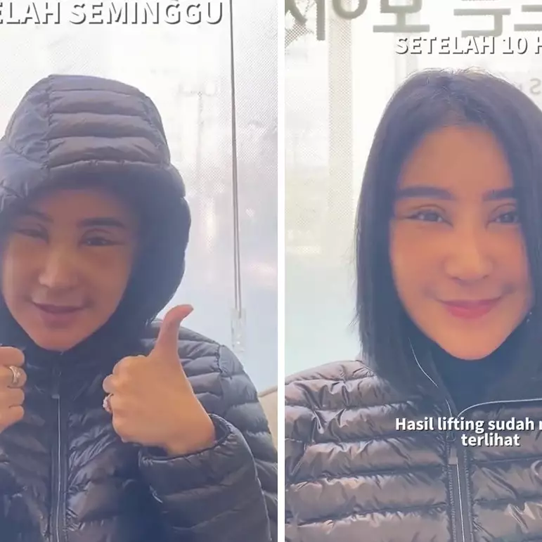 Lakukan facelift untuk hilangkan kerutan, 9 potret Uut Permatasari usai oplas bikin tampak awet muda