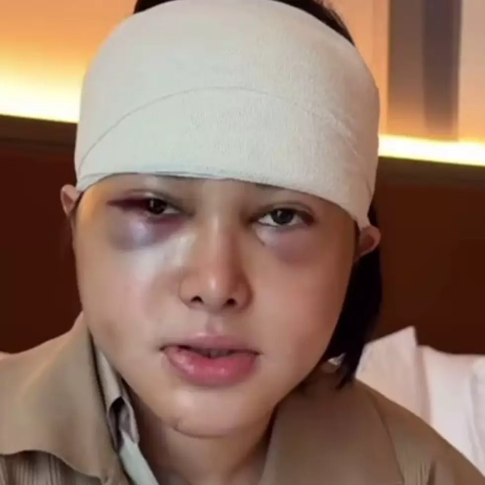 9 Potret Dilan Janiyar seleb TikTok usai oplas di Korea, tak banyak berubah tetap cantik natural