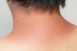 Bisa merata seperti sediakala, ternyata begini cara simpel pudarkan kulit belang pakai 1 jenis tepung