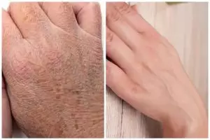 Cara melembutkan kulit tangan kering dan keriput ini ampuh tanpa lotion, cukup pakai 3 bahan dapur