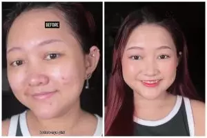 Tanpa ditutup satu-satu pakai concealer, ini trik samarkan bekas jerawat agar complexion tak abu-abu