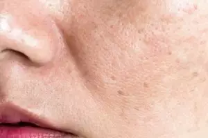 Cara memutihkan kulit dari noda hitam membandel pakai 1 jenis buah, auto glowing bak perawatan salon