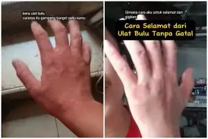 Trik agar kulit tak gatal dan nyeri usai digigit ulat bulu, sekarang atasi pakai 2 bahan dapur