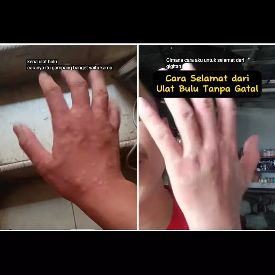 Trik agar kulit tak gatal dan nyeri usai digigit ulat bulu, sekarang atasi pakai 2 bahan dapur