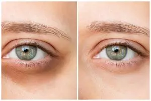 Nggak perlu krim mahal, ini cara ampuh dan aman menghilangkan mata panda cuma modal Rp0