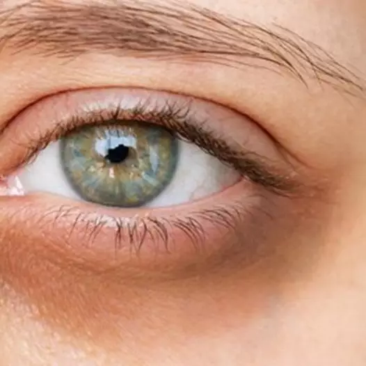 Nggak perlu krim mahal, ini cara ampuh dan aman menghilangkan mata panda cuma modal Rp0