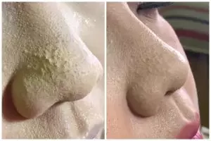 Complexion berlubang karena jerawat? Jangan buru-buru dihapus, begini cara mengatasinya pakai 1 alat