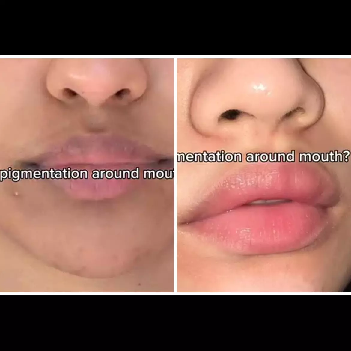 Area bibir gelap karena hiperpigmentasi? Ternyata ini cara mencerahkannya pakai 1 rempah dapur