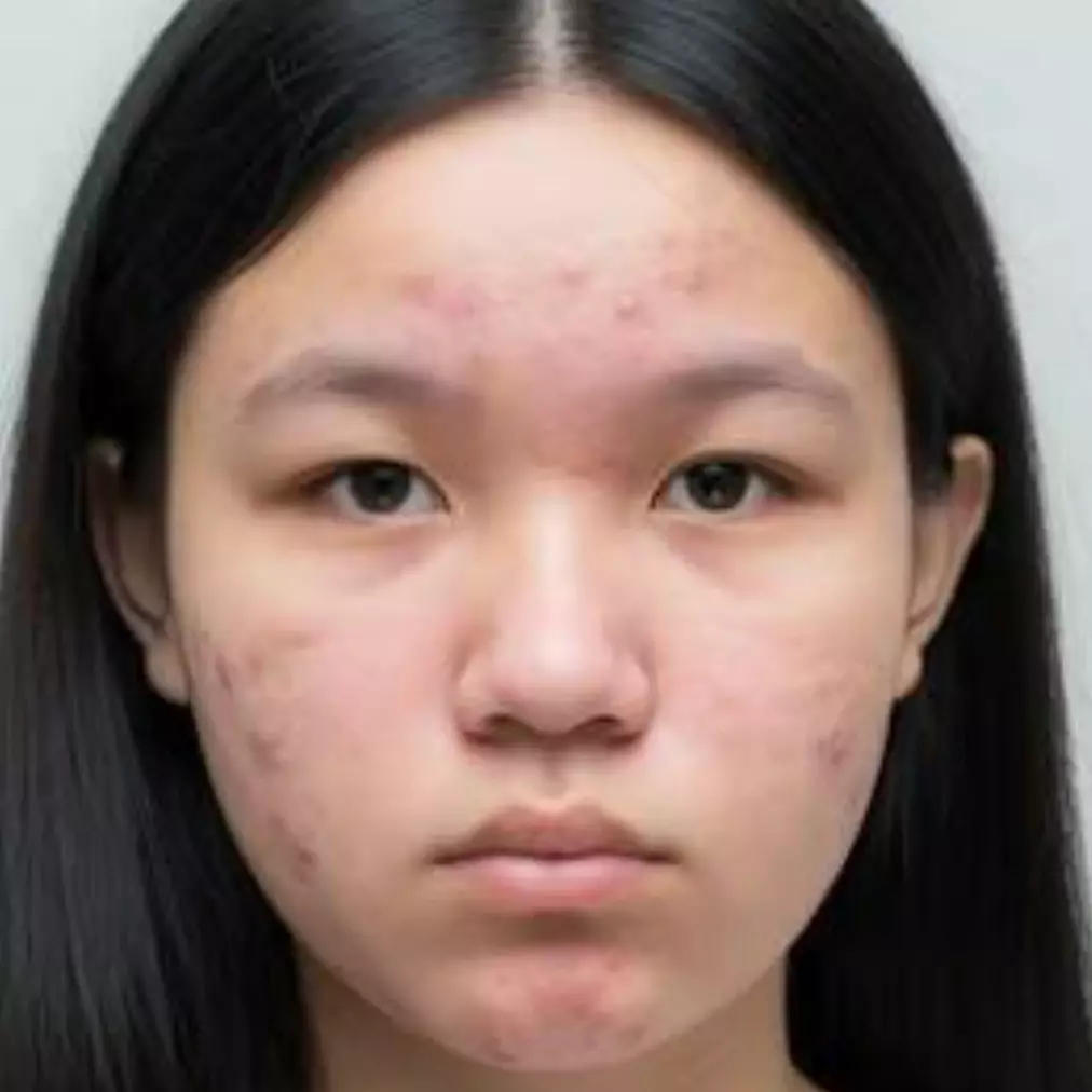 Bebas jerawat dalam 30 hari, ini tips skincare routine yang patut dicoba