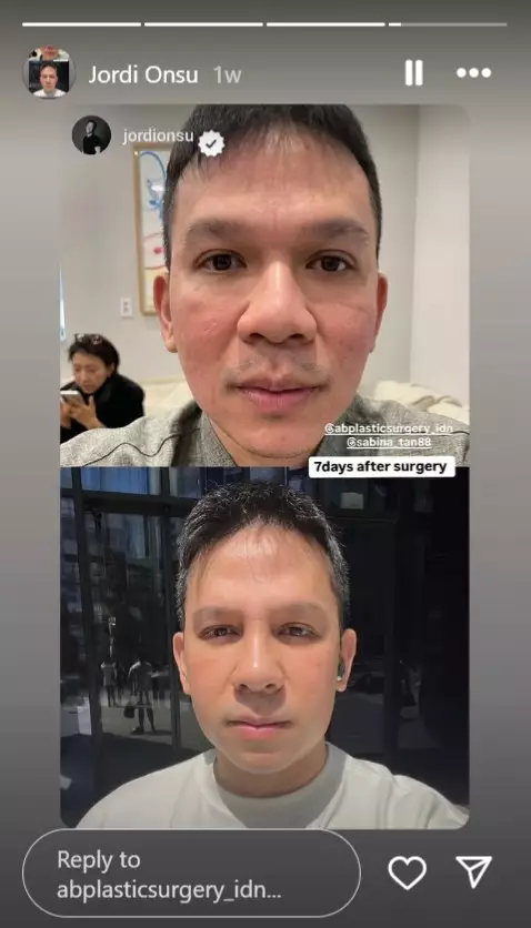 Jordi Onsu sebelum dan sesudah oplas © berbagai sumber