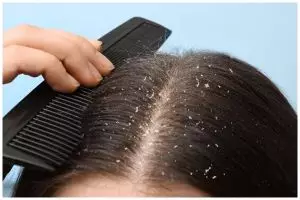 Bukan pakai shampo mahal, cara baru atasi ketombe ini bikin kulit kepala bersih bermodal 1 rempah daun