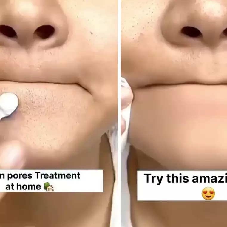 Kulit mulus tanpa iritasi, ini cara hilangkan komedo hitam dan bruntusan di dagu pakai 1 bahan pemanis