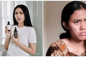 Retinol vs niacinamide, mana paling ampuh hilangkan flek hitam dan jerawat? Ini panduan lengkapnya