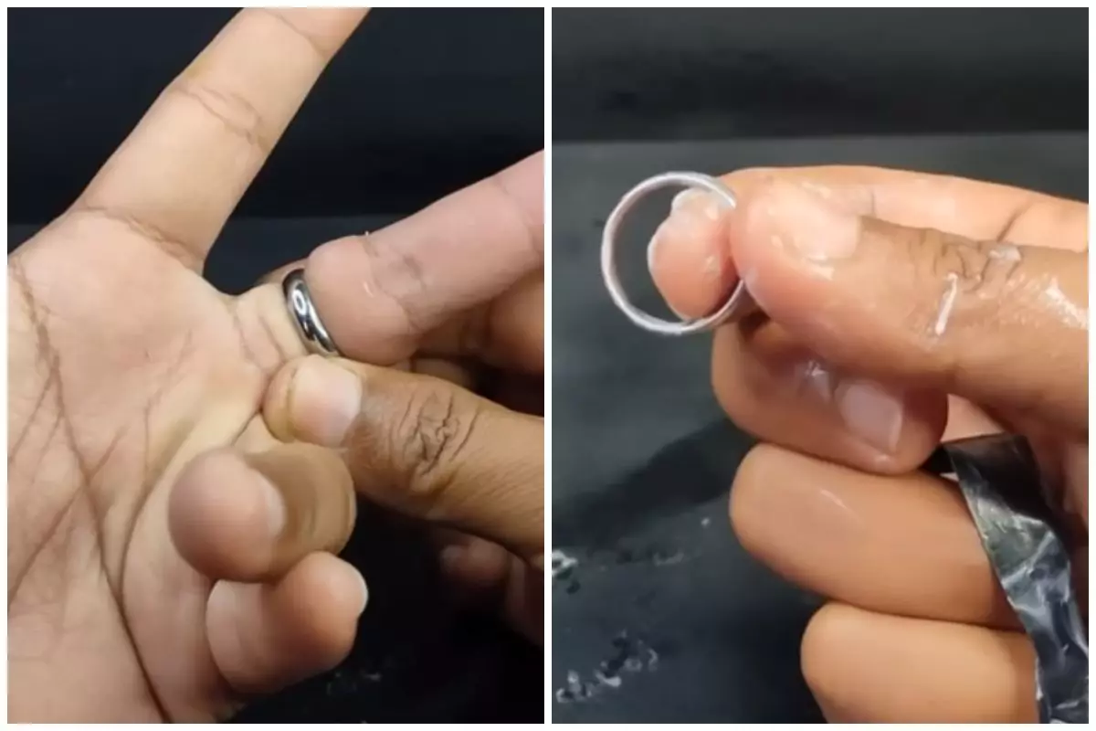 Melepas cincin kekecilan tanpa harus pakai sabun, begini triknya sekarang andalkan 1 alat sederhana