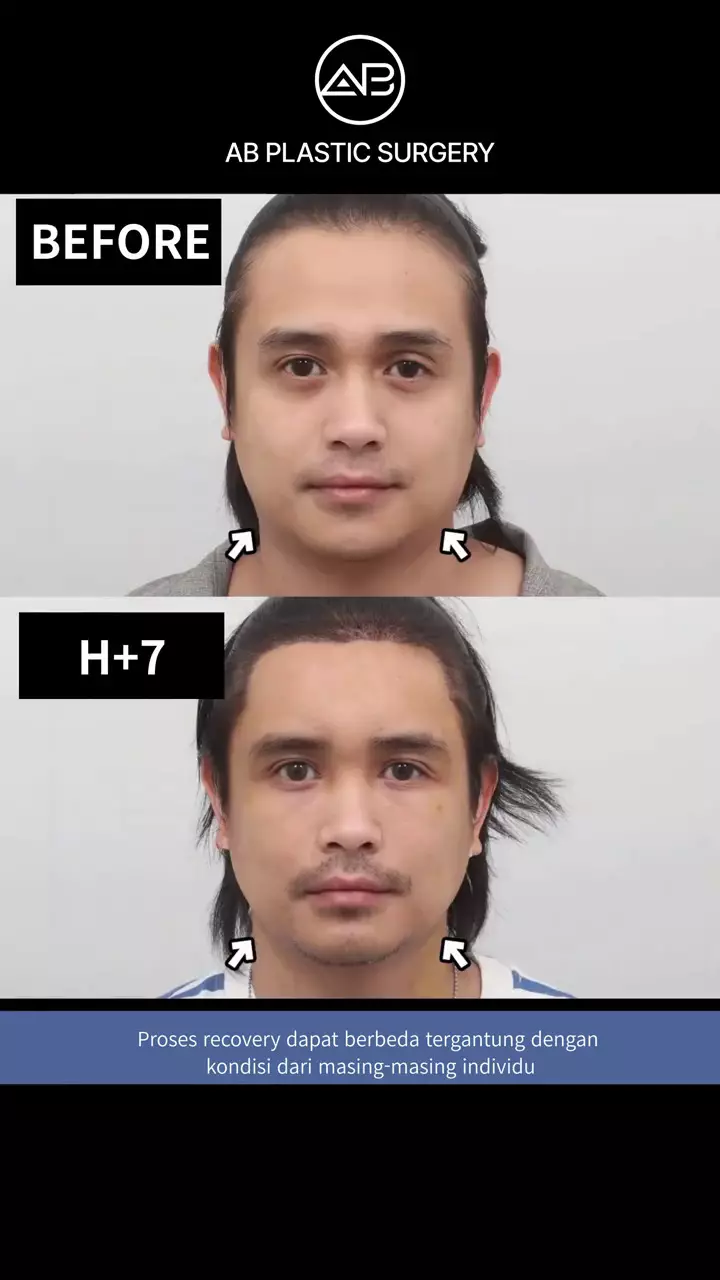 ajun perwira operasi plastik © 2025 TikTok ajun perwira operasi plastik © 2025 TikTok