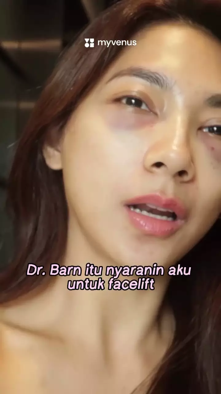 dinda kirana jalani oplas wajah dan badan  © 2025 Instagram