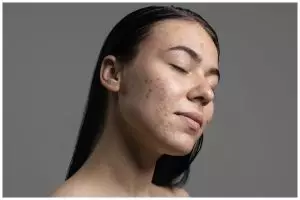 Bekas jerawat hilang dalam 3 hari, wanita ini cuma pakai masker alami dari 3 bahan dapur