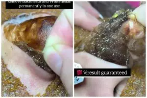 Tak perlu beli lagi, begini cara bikin pore pack yang ampuh bersihkan komedo dalam sekali pakai