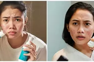 Kandungan salicylic acid vs benzoyl peroxide, mana lebih ampuh untuk jerawat?
