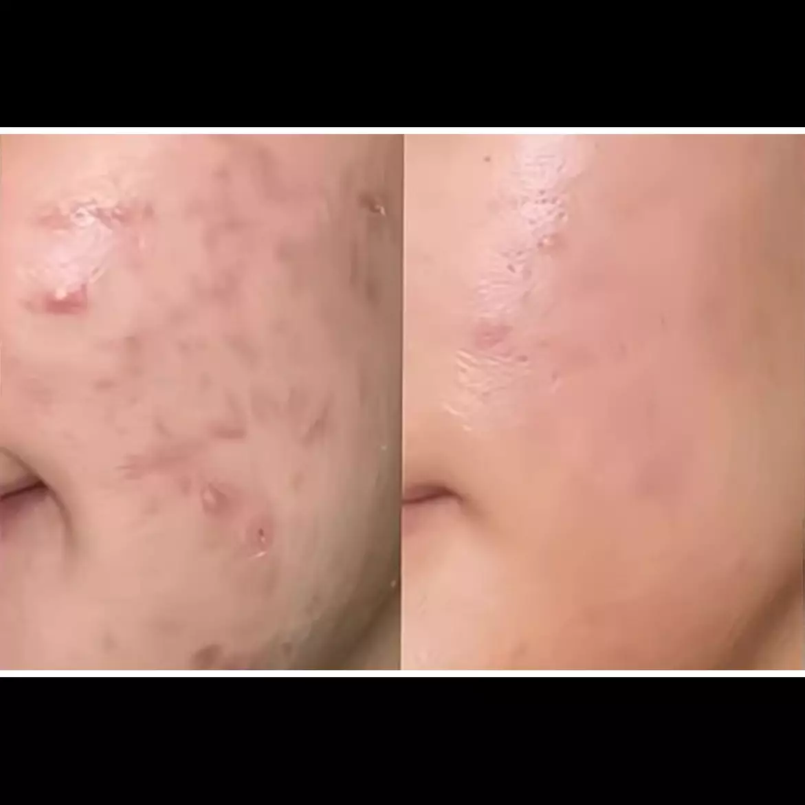 Aman untuk ibu hamil, ini cara alami hilangkan jerawat dalam 3 hari cuma pakai 1 kulit buah