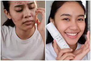 Kulit kusam dan bruntusan? Ini skincare routine simple yang bisa bikin cerah dalam 7 hari