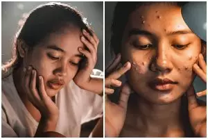 Kenali 7 tanda skin barrier rusak dan cara ampuh memperbaikinya dalam seminggu