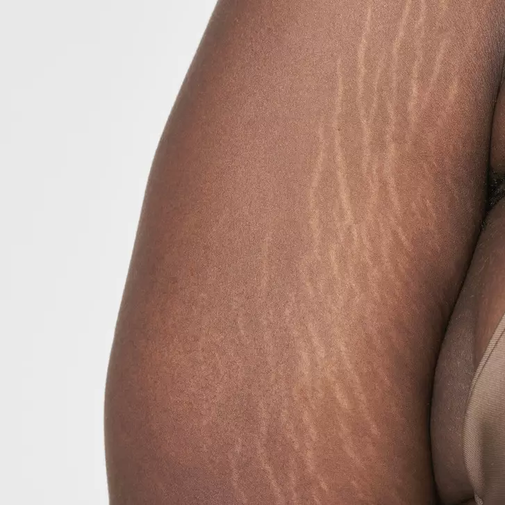 Tak perlu dilaser, ini cara alami hilangkan stretch mark agar kulit mulus dan tampak kencang lagi