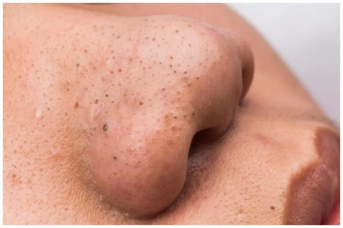 Tak perlu dikompres es batu dulu, ini cara ampuh hilangkan komedo hitam di hidung pakai 2 bahan dapur