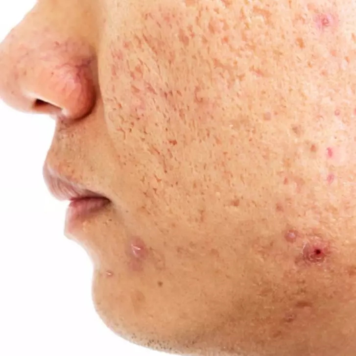 Wajah breakout jadi lebih mulus tanpa ke klinik, ini cara mengatasinya cuma dengan 1 jenis buah