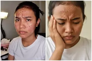 Wajah nggak mulus-mulus? Ini alasan jerawat tak kunjung hilang dan solusi skincarenya