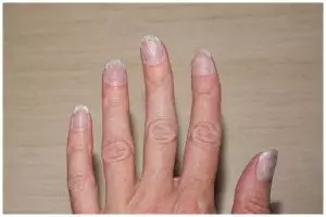 Kuku sering patah dan jamuran? Ini cara ampuh mengatasinya cuma dengan 2 bahan dapur