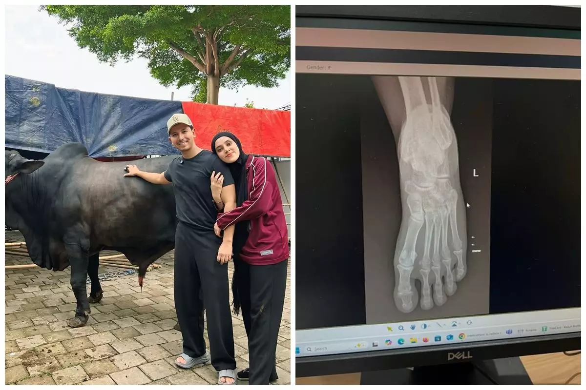 Kondisi Fairuz A Rafiq usai kakinya terinjak oleh sapi kurban dari Raffi Ahmad, alami memar