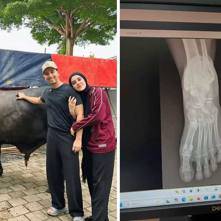 Kondisi Fairuz A Rafiq usai kakinya terinjak oleh sapi kurban dari Raffi Ahmad, alami memar