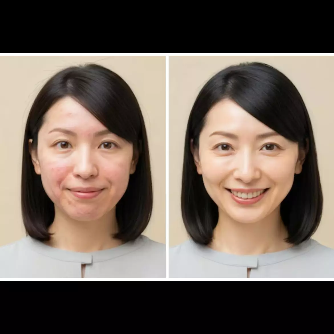 Tanpa bahan kimia, cara redakan peradangan di wajah akibat jerawat ini ampuh nggak bikin perih