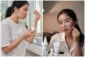 5 Kandungan skincare yang sebenarnya nggak cocok untuk semua kulit