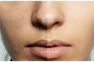 Cara atasi minyak berlebih di wajah tanpa bikin kulit kering pakai toner dari 1 jenis tanaman ini