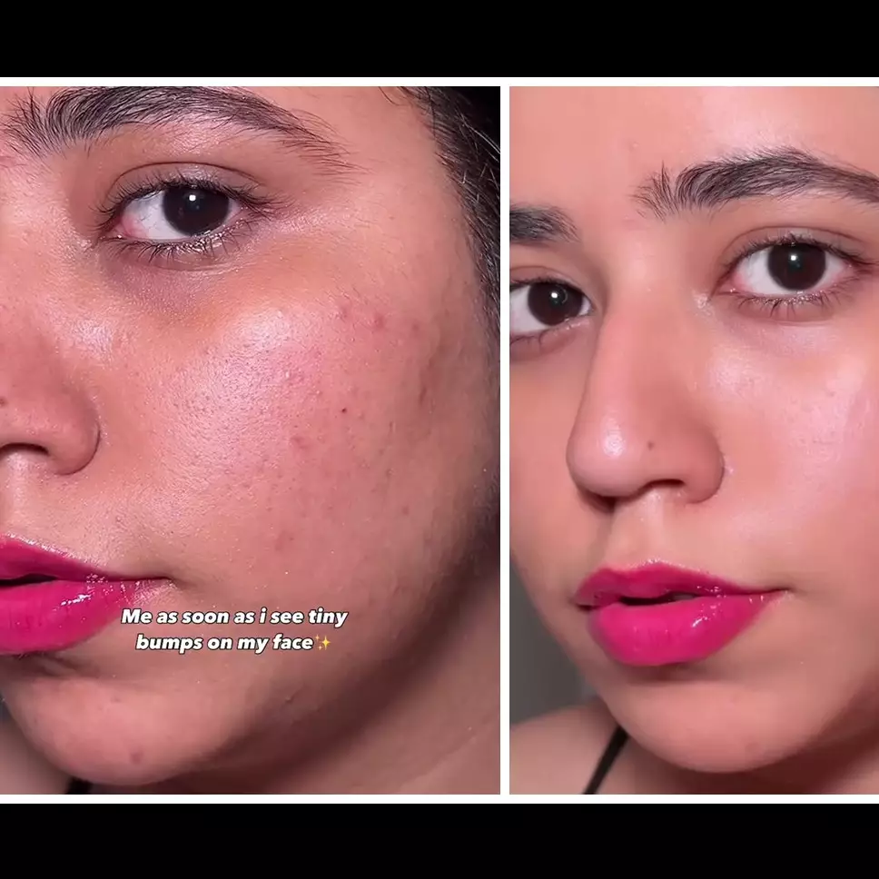 Beruntusan auto hilang dalam sekali usap, cara alami eksfoliasi wajah ini cuma butuh 2 bahan dapur