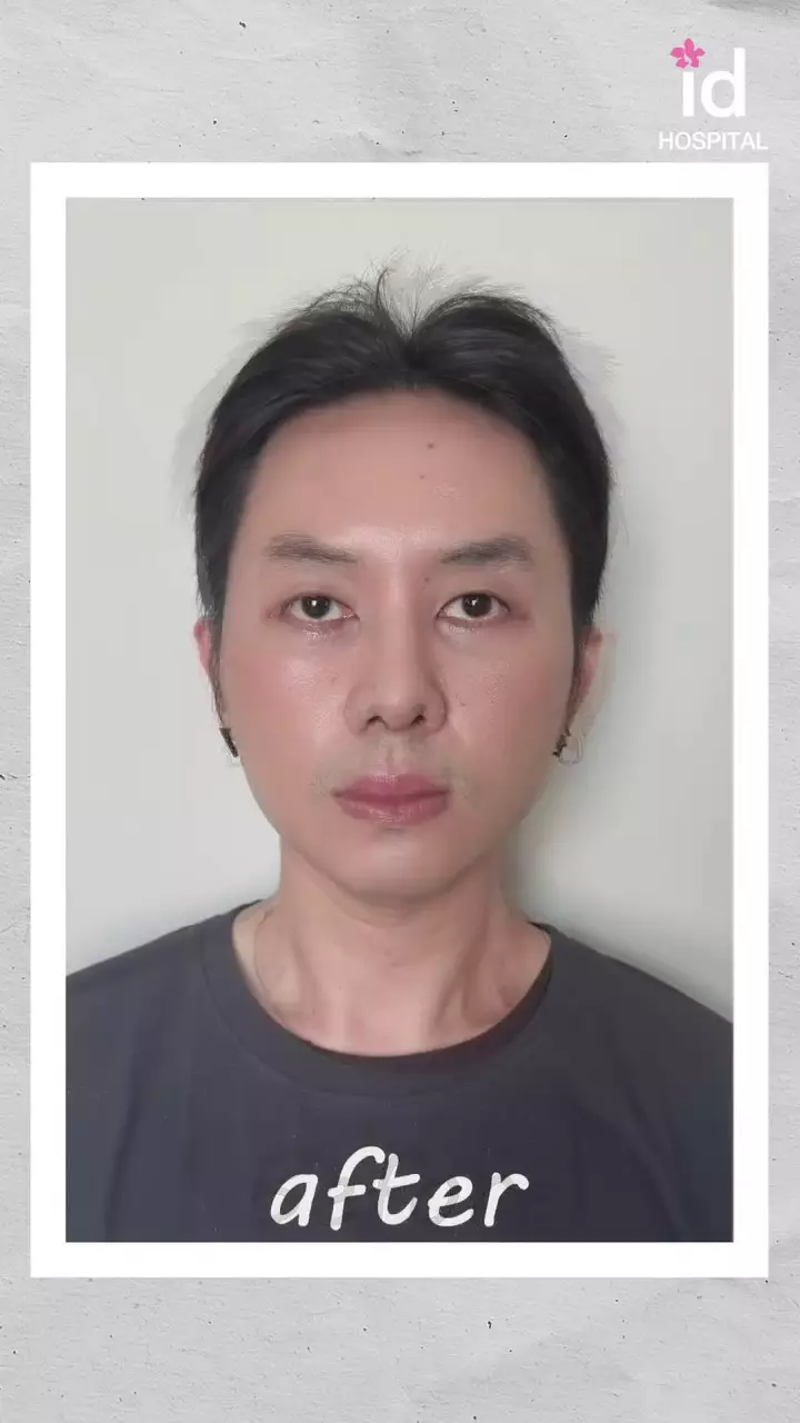 Rafael Tan operasi plastik © 2025 Instagram Rafael Tan operasi plastik © 2025 Instagram