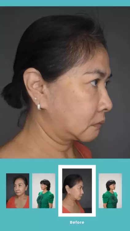 transformasi Yurike Prastika oplas anti aging © Instagram