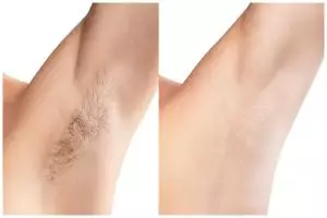 Cara ampuh hilangkan bulu ketiak secara permanen tanpa khawatir iritasi, cukup pakai 1 buah ini