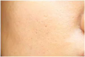 Bukan pakai bubuk kopi, begini cara bersihkan pori-pori tersumbat kotoran pakai 1 produk fermentasi