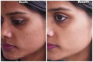 Tak perlu laser, ini cara mengatasi bopeng biar wajah mulus pakai masker dari 1 kulit buah