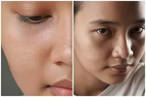Sering salah pilih skincare? Ini 7 kandungan yang harus dihindari kulit berpori besar