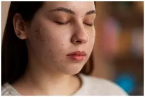 Tak banyak yang tahu, ternyata jenis rempah ini bisa ampuh samarkan bekas jerawat dalam hitungan hari