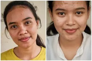 Jangan keliru, ini perbedaan pori-pori besar dan komedo serta cara mengatasinya