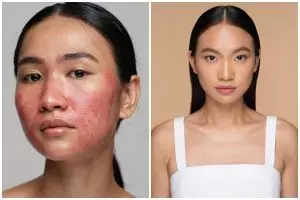 Kulit sensitif? Ini tips skincare aman tanpa alkohol dan parfum yang wajib dicoba
