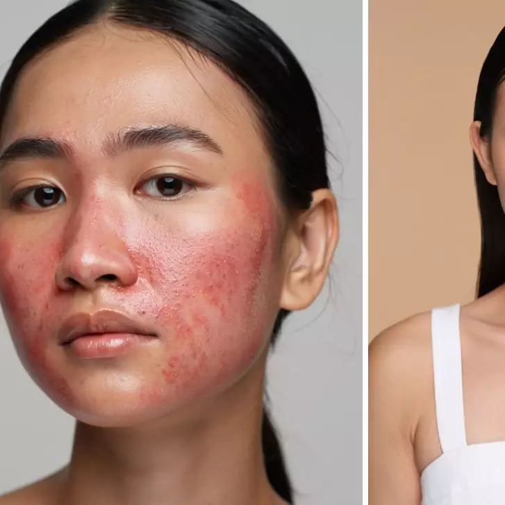 Kulit sensitif? Ini tips skincare aman tanpa alkohol dan parfum yang wajib dicoba