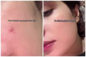 Bukan pakai acne patch, ini cara cepat menghilangkan jerawat aktif dalam 2 hari bermodal Rp0