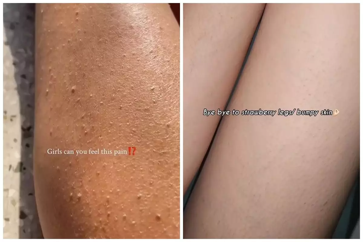 Strawberry skin bikin kulit bertekstur, ini cara mengatasinya cuma pakai scrub dari 3 bahan dapur