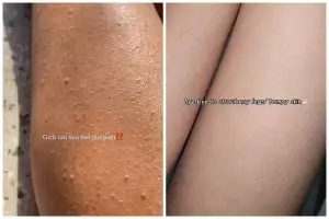 Strawberry skin bikin kulit  bertekstur, ini cara mengatasinya cuma pakai scrub dari 3 bahan dapur